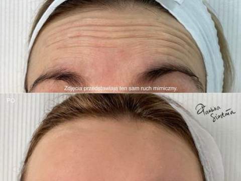 Botox efekty po 2tyg 