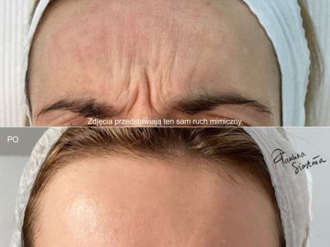 Botox efekty po 2tyg 