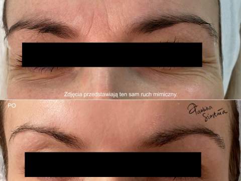 Botox efekty po 2tyg 